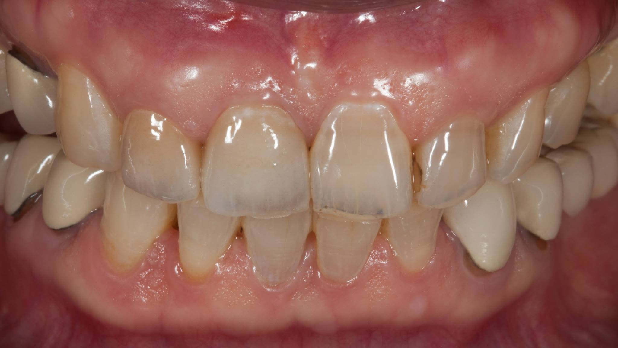 Laminate lingual view